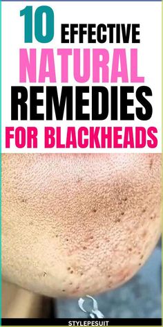 Are looking for blackheads removal at home remedies. Click to read How to get rid of blackheads diy| The best blackheads removal on nose| get rid of blackhads on face| get rid of blackheads on nose| how to get rid of blackheads naturally #blackheads #skincare #DIY #Beauty Nose Acne, What Are Blackheads, Acne Home Remedies, For Blackheads, Nose Picking, Blackhead Remedies, Blackheads On Nose, Rid Of Blackheads, Blackhead Mask