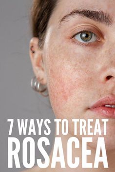 If you have rosacea on your nose, cheeks, and/or neck, this collection of rosacea remedies, products, and makeup tips will help! Diy Natural Remedies, Skin Care 30s Women, Home Remedies For Face, Natural Wrinkle Remedies, Rash On Face, Step By Step Makeup, Natural Remedies For Migraines