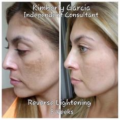 How To Get Rid Of A Blind Pimple Under The Skin - DocPe How To Get Rid Of A Blind Pimple Under The Skin Rodan Fields Skin Care, Reverse Aging Skin, Rodan And Fields Reverse, Tumeric Face Mask, Life Changing Skincare, Natural Organic Skincare, Sensitive Skin Care, Skin Discoloration