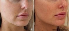 Nasolabial Folds Dermal Fillers Before And After, Filler For Nasolabial Folds, Filler Nasolabial Folds, Nasolabial Folds Filler, Derma Fillers Before And After, Dermal Fillers Before And After, Chin Botox Before And After