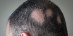 Hair Diseases, Stimulate Hair Follicles, Regrow Hair, Hair Problems