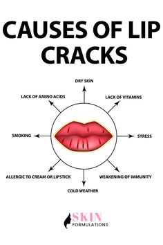 Figuring out the cause of cracked lips is the first step to healing them! #Skinformulations #SFs #sf #lips #lipscare #drylips #softlips #skin #skincare #dryskin #stress #vitamins #coldweather #lipscaretips #causes #lipscracks #cracks #health Lipgloss Photography, Lipcare Skincare, Abdominal Stretches, Swollen Lips, Lip Ice