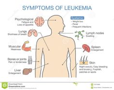 Common Symptoms And Signs Of Leukemia. Stock Vector - Illustration of bacteria, diagnose: 102726985 High Blood Pressure Chart, Diagram Illustration, Blood Pressure Chart, Oncology Nursing, Ab Challenge, Nursing School Notes, Lymph Nodes, Medical Knowledge, Medical Illustration