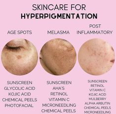 Skincare For Hyperpigmentation, Esthetician Inspiration, Esthetician School, Haut Routine, Esthetician Marketing, Skin Facts, Skin Care Business, Skin Care Guide, Skin Advice