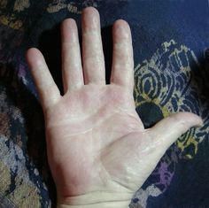 a person's hand with white spots on it