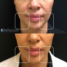 Pre-Jowl Sulcus Filler Rhinoplasty Nose Jobs, Beauty Procedures, Facial Plastic Surgery