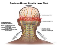 Occipital Nerve Block, Nerve Anatomy, Forward Head Posture Exercises, Forward Head Posture, Chronic Migraines, Muscle Spasms, Migraine Headaches, The Skull