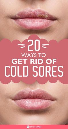 Cold sores are painful and embarrassing. Click here to learn about how to get rid of cold sores, including their causes, home remedies, and prevention tips. Cold Sore Remedy Fast, Natural Remedies For Headaches, Home Remedies For Allergies, Wrinkles Hands, Remedies For Headaches, Natural Remedies For Migraines, Cold Sore Remedies