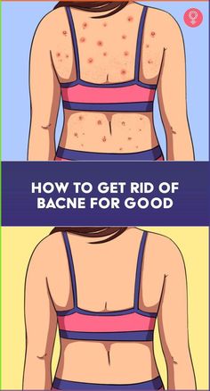 How To Get Rid Of Bacne For Good: That’s right, while acne ravages your face, bacne converts your smooth back into its pockmarked territory. The other drawback of having bacne is also that you never get to showcase your beautiful back in those beautiful sundresses. Now, that would be a shame, wouldn’t it? Backne Remedies Fast, How To Clear Back Acne, How To Get Rid Of Back Acne, Backne Remedies, Remedies For Back Acne, Acne Scab, Summer Perfumes For Women, Best Summer Perfumes, Back Acne Remedies