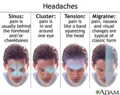 Chinese herbal medicine, acupuncture and cupping can be great for all types of headaches! There can be dietary influences as well that could be the cause of each of these. Different Types Of Headaches, Autogenic Training, Headache Relief Instant, Headache Types, Natural Headache Remedies, Migraine Relief, Tension Headache, Headache Relief, Migraine Headaches