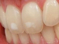 Dental Fluorosis, Baking Soda Toothpaste, Remedies For Tooth Ache, Kids Teeth, Dental Bridge, Tooth Enamel, The Teeth, Tooth Extraction, Stained Teeth