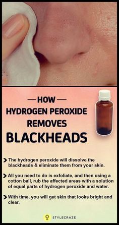 It is by using hydrogen peroxide. Wondering how that can help you remove your blackheads? Then read this post! Curly Man, For Blackheads, Black Heads, Get Rid Of Blackheads, Cystic Acne, Image Skincare, Hydrogen Peroxide, Looks Black