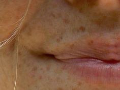 a woman with acne on her face