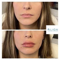 Small Mouth With Lip Injections, Heavy Upper Lip Filler, Natural Lips Filler, Sarah Cameron Lip Filler, Bottom Heavy Lip Filler, 1ml Lip Filler Small Lips, Lip Filler Heavy Upper Lip, Lip Filler Bottom Lip Bigger, Nessa Barrett Lip Filler