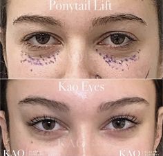 Eye Lift Surgery, Face Plastic Surgery, Easy Cat Eye, Cat Eye Tutorial, Rhinoplasty Nose Jobs, Face Fillers, Plastic Surgery Gone Wrong, Eye Tricks, Facial Fillers