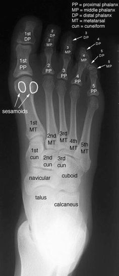 an x - ray view of the foot and bones showing different types of metataximals