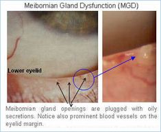 Eye Blepharitis - Definition, Types & Treatment | EYE PRESS | EYE PRESS Eye Mites, Eye Stye Remedies, Eye Conditions, Eye Pain, Facial Massage Tool, Dry Eyes Relief, Southern Desserts, Eye Infections