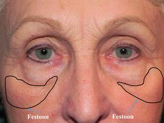 touched. Saggy Face Skin, Eye Bag Surgery, Saggy Face, Facelift Without Surgery