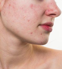 Red spots on the face can give you a blotchy and uneven skin tone. This article offers holistic and natural home remedies to reduce their appearance. Read on! Red Bumps On Face, Red Spots On Face, Redness On Face, Rash On Face, Redness Pimple, Home Remedies For Skin, Skin Tightening Face