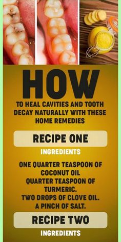 One Simple Way To Maintain Your Healthy Teeths and Gums🔥 Heal Cavities, Teeth Health, Receding Gums, Home Health Remedies, Cold Home Remedies, Oral Health Care, Natural Health Remedies, Tooth Decay, Healthy Teeth