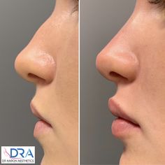 Nose Ideas, Nose Lift, Nose Fillers, Lips Inspiration, Botox Lips, Facial Fillers