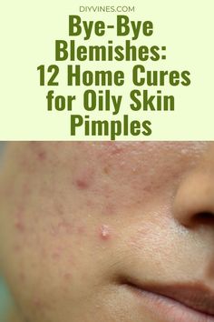 7 Days Challenge- Remove DARK SPOTS, BROWN SPOTS, PIMPLE MARKS, PIGMENTATION Naturally at Home Blemish Remedies, Pimple Solution, Tighten Facial Skin, Acne Help, Face Care Routine