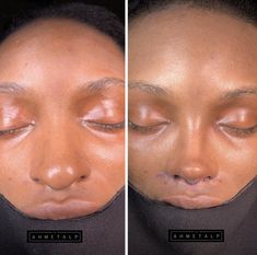 Rib Removal Surgery, Nose Job Transformation, Nose Surgery Before And After, Black Women Nose Job, Plastic Surgery Black Women