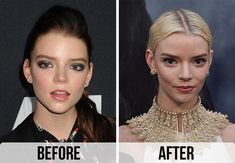 Check out before and after pictures of Anya Taylor-Joy which suggest she may have had buccal fat removal surgery on SheFinds.com Buccal Fat Removal, Career Photos, Eyebrow Lift, Brow Lift, Queen Pictures, Unique Faces, After Pictures, Nose Job