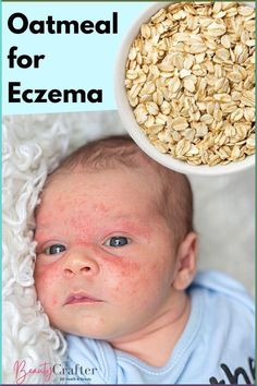 Oatmeal is a great natural remedy for eczema outbreaks and it is safe for baby. Learn more about the benefits of oats in treatment and how to use colliodal oatmeal to soothe eczema related skin inflammation. Benefits Of Oats, Toxic Skincare, Skin Detox, Holistic Beauty, Sensitive Skin Care, Cruelty Free Skin Care, Natural Remedy, Diy Health