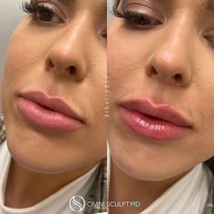 Lip Injection Before & After Gallery | OMNI SCULPT MD Makeup Routine, Hair Makeup, Makeup