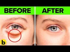 Eye Bag Remedies, Bags Under Eyes, Dry Eyes Causes, Under Eye Wrinkles, Under Eyes, Dark Circles Under Eyes, Eye Wrinkle, Under Eye Bags