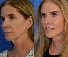 Vertical Facelift - Endoscopic Temporal Lift - Stem Cell Facial Rejuvenation with fat grafting - Lip Lift Face Procedures, Lip Lift, Cell Rejuvenation, Face Lift Surgery, Fat Grafting, Facial Plastic Surgery