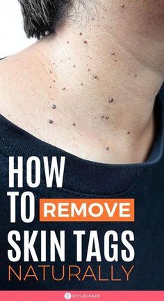 You don’t need expensive cosmetic surgeries for skin tag removal. Instead, try these natural home remedies for skin tags to manage them. Click to learn more. Surgical Scissors, Home Remedies For Skin, Liquid Nitrogen, Skin Natural Remedies, Cold Sores Remedies