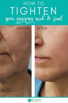 Increase your skin's firmness using Pepha Tight, a neck firming and tightening treatment for sagging jowls. "Turkey Neck" begins to appear in the '40s. Sagging Jowls, Neck Firming, Natural Hair Mask, Anti Aging Secrets, Boost Hair Growth, Anti Aging Ingredients, Anti Aging Beauty, Diy Skincare