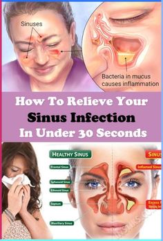 Especially during allergy season, I wake up daily so stuffed up. I can’t breathe through my nose, my eyes itch, and it’s all around not a very fun experience. A few years ago, I stumbled upon this method to relieve sinus congestion. Of course, this alone won’t fix the problem permanently. Kicking up the spicy … Sinus Blockage, Relieve Sinus Congestion, Clear Your Sinuses, Blocked Sinuses, Maxillary Sinus, Sinus Congestion Relief, Sinus Cavities, Beauty Tips With Honey, Cold Or Allergies