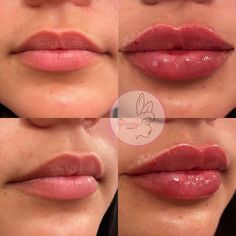 1ml Lip Filler Small Lips, Lip Fillers Heart Shape, Lip Fillers On Black Women, Jolie Lip Filler, Russian Style Lip Fillers, Defined Cupids Bow Lip Filler, Slight Lip Filler, Beautiful Lips Aesthetic, Kysse Lips Filler