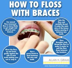 Orthodontic Humor, Braces Ideas, Braces Dentist, Dentistry Humor, Office Marketing, Flossing Teeth, Lingual Braces