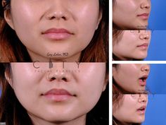 Lip Lift Before and After | New York Plastic Surgeon Dr. Linkov