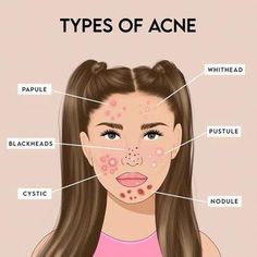 It doesn't matter if you're a teen suffering from acne, or an adult suffering from acne related to stress or hormones; it hurts to have acne.  I know what it's like to suffer from acne and not know where to turn to for acne help.So, here are all the effective treatments for acne with some additional skin-care tips to prevent it from ever happening: Acne Scar Removal Cream, Back Acne Remedies, Scar Removal Cream, Acne Help, Types Of Acne