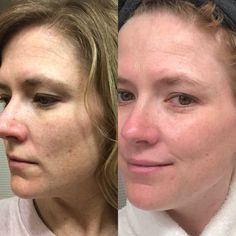 EVER Skin before and after from using Overnight Facial Oil with retinol. Image of woman's face before and after using retinol. Retinol Oil, Skincare Brand, Oily Skin Care, Anti Aging Skin Products, Facial Oil, Female Images