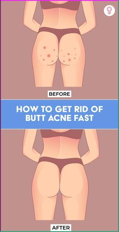 How To Get Rid Of Butt Acne Fast: The thought of having itchy, painful, and angry spots on your butt in your favorite swimsuit can be distressing. But if you feel all those dreams of wearing a swimsuit are crushed, think again. There are simple and quick remedies you can try at home to get rid of these pimples on buttocks. In this article, we delve deeper into the several home remedies you can try to say goodbye to butt acne. Pimples On Buttocks, Bad Skin, Acne Overnight, Natural Acne Remedies, Natural Acne, Acne Causes, Acne Solutions, Grade 7, Clearer Skin