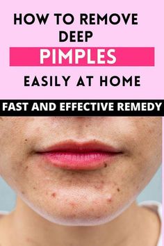 Buttocks Acne, Deep Pimple, Remedies For Pimples, Get Rid Of Pimples Overnight, Rid Of Pimples Overnight, Pimples On Buttocks, Seasonal Skincare, Home Remedies For Pimples, Get Rid Of Pimples