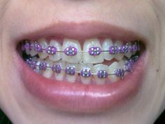 Green Braces, Kids Braces, Braces Tips, Getting Braces, Health Aesthetic