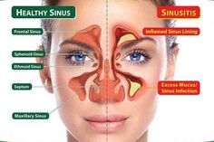 This is the time of the year when you are getting those coughs or wet noses and you need to clear sinuses. The sinuses are under attack collecting whatever they can to make you hate winter. If you dig deeper into the problem you have with the sinuses, you’ll find out there are more things Jus Lemon, Blocked Sinuses, Sinus Remedies, Maxillary Sinus, How To Clear Sinuses, Sinus Infection Remedies, Sinus Problems