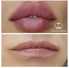 Round Lip Filler Shape, Round Lip Filler, 90s Latina Makeup, Round Lips, Lip Fillers Juvederm, Big Lips Natural