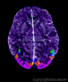 an image of a brain scan showing the area where it has been colored purple and green