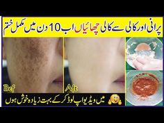 How To Get Rid Of Freckles In Just 10 Days At Home In Urdu | Skin Care Tips In Urdu | Freckles Tips - YouTube Getting Rid Of Freckles, Workout Beginner, Bodyweight Workout Beginner, Homemade Remedies, Skin Care Remedies, Breakup Quotes, Skin Care Solutions