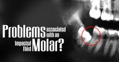 Problems associated with an Impacted Third Molar? - Infection - Gum diseases - Bacteria and plaque buildup Causes Of Bad Breath, Oral Surgeon, Dental Veneers, Dental Crowns, Periodontal Disease, Cary Nc, Root Canal, Dental Services, Dental Implants