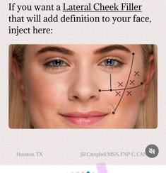 Natural Cheek Filler, Facial Balancing Filler, Cheek Injections, Botox Migraine, Fillers Aesthetic, Face Injections, Face Plastic Surgery, Facial Injections