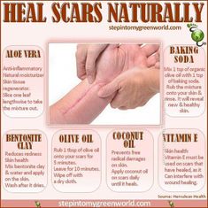 Scar Remedies, Olive Oil Skin, Heart Diet, Types Of Acne, Acne Scar Removal, Skin Tissue, Scar Removal, Scar Tissue, Natural Moisturizer